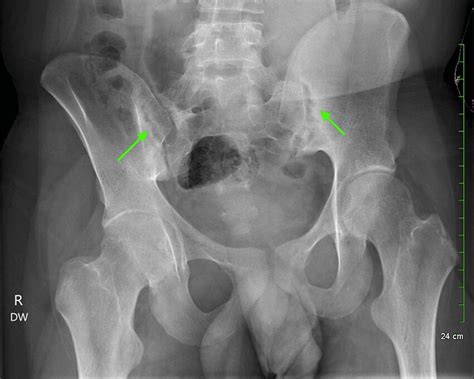 x ray for sacroiliac joint